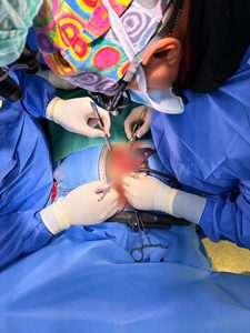 Donazione a cuore fermo (DCD) al Monaldi, prelevati fegato e cornee grazie ad una procedura ad alta complessità